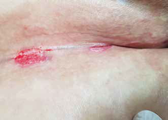 Brust intertrigo Desitin for